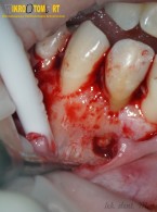 ARTYKUŁ Z FILMEM: Resekcja wierzchołka korzenia z użyciem lasera po powtórnym leczeniu endodontycznym. Opis przypadku