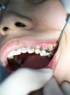 Wpływ różnych technik kondycjonowania porcelany na siłę utrzymania zamków ortodontycznych. Przegląd piśmiennictwa