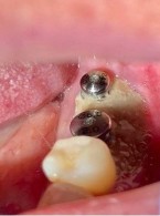 Martwica kości żuchwy zaopatrzonej implantami w przebiegu terapii bisfosfonianami