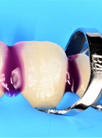 REPORTAŻ KLINICZNY: Zamykanie diastem. Analiza potencjalnych błędów na bazie własnych doświadczeń klinicznych