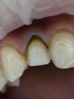 REPORTAŻ KLINICZNY: Naprawa uszkodzonej licówki ceramicznej z zastosowaniem odłamanego fragmentu i materiału kompozytowego