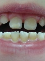 Hipomineralizacja trzonowcowo‑siekaczowa. Opis przypadku