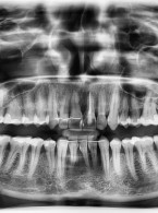 Zastosowanie ekstruzji ortodontycznej do rekonstrukcji ubytków tkanek przyzębia. Opis przypadku