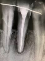 Zespół endodontyczno‑periodontologiczny i jego wpływ na przyzębie Metodyka leczenia z zastosowaniem lasera – opis przypadku