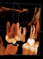 Kryteria oceny prawidłowości leczenia endodontycznego jako etapu przygotowawczego do leczenia protetycznego. Na podstawie piśmiennictwa i doświadczeń własnych