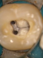 ARTYKUŁ Z FILMEM: Endodoncja ekstremalna czy kompromisowa? Opis przypadku