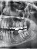 Uzupełnienie braku zęba 36, a konieczność leczenia kanałowego zęba 26 z powodu Efektu Godona – leczenie kanałowe jako jeden z etapów leczenia u pacjentów z zaburzeniami okluzji