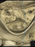 Powtórna endodoncja mikroskopowa z mikrochirurgią endodontyczną zęba 16 w czteroletniej obserwacji – opis przypadku