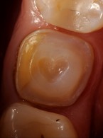 REPORTAŻ KLINICZNY. Z miłości do adhezji. Kompozytowa rekonstrukcja korony zęba trzonowego po leczeniu kanałowym