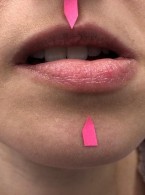 Syndrom Ernesta – zapalenie przyczepu więzadła rylcowo-żuchwowego