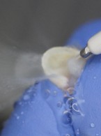Biomimetyczna koncepcja leczenia zębów urazowych w obrębie przedniego odcinka łuku zębowego