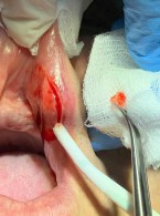 Akrylowe ciało obce w wardze górnej – opis przypadku