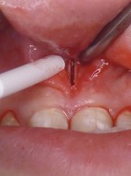 REPORTAŻ KLINICZNY. SARPE jako technika chirurgiczna ekspansji szczęki u pacjentów dojrzałych szkieletowo 