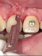 REPORTAŻ KLINICZNY. Dwuetapowa korekta tkanek miękkich wspomagająca leczenie ortodontyczne wprowadzające do łuku zatrzymany ząb sieczny przyśrodkowy