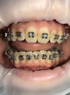 Leczenie ortodontyczne aparatami stałymi młodocianej pacjentki chorej na cukrzycę typu 1 – opis przypadku