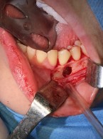 Mnogie zęby nadliczbowe żuchwy. Opis przypadku