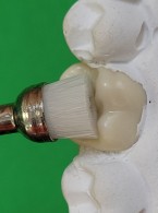 SPECJALISTA RADZI: Odbudowa powierzchni żującej zębów bocznych metodą stempla okluzyjnego