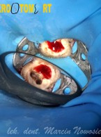REPORTAŻ KLINICZNY. Opis przypadku ponownego leczenia kanałowego zęba 47 z przewlekłym zaostrzonym stanem zapalnym tkanek okołowierzchołkowych przy użyciu laserów Er:YAG i Nd:YAG (...)