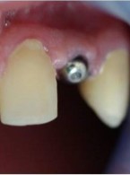 Uzupełnienie wrodzonego braku zawiązków stałych zębów siecznych bocznych w szczęce...