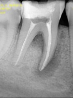 Leczenie endodontyczne zęba 46 z przewlekłym ropnym zapalaniem tkanek okołowierzchołkowych – opis przypadku