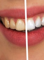 Rzadki obraz kliniczny i diagnostyka dziąsłowego melanoacanthoma spowodowanego stosowaniem pasków wybielających zęby: opis przypadku