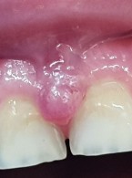 Ciążowe zapalenie dziąseł. Przegląd piśmiennictwa