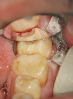 ARTYKUŁ Z FILMEM: Opis przypadku leczenia kanałowego zęba 37 z przewlekłym stanem (...)