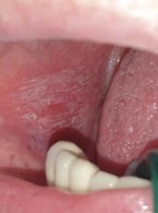 Leczenie postaci zanikowo-nadżerkowej liszaja płaskiego (...) 