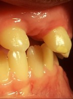 Zęby dwoiste. Terapia wielospecjalistyczna pacjenta