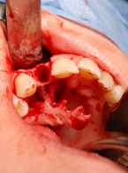 Leczenie torbieli korzeniowej szczęki z zastosowaniem materiału kościozastępczego (...)