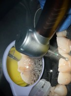 Aerozole i rozpryski w stomatologii rekonstrukcyjnej (...)