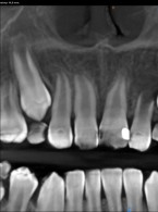 REPORTAŻ KLINICZNY. Leczenie endodontyczne zęba z niezakończonym rozwojem korzenia (...)