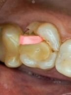 Adhezyjne uzupełnienia pośrednie w złamanych zębach bocznych – analiza problemu klinicznego