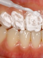 SPECJALISTA RADZI: Znoszenie nadwrażliwości zębów, szczególnie u pacjentów po zabiegu wybielania zębów