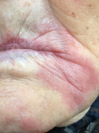 Kandydoza jamy ustnej – jak ją rozpoznać i prawidłowo leczyć?