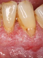 Pemfigoid błon śluzowych – trudności diagnostyczno‑lecznicze (...)