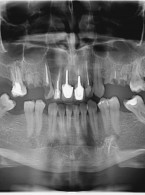 Potencjał naprawczy tkanek okołowierzchołkowych zębów (...)
