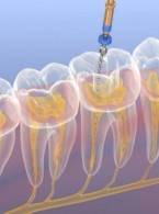 Powikłania leczenia endodontycznego podczas opracowywania kanałów (...)