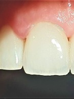 Usuwanie licówek pełnoceramicznych w odcinku przednim (...)