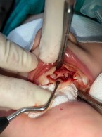 Chirurgiczne leczenie intruzji zębów mlecznych. Opis przypadku