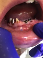 Rehabilitacja protetyczna z zastosowaniem leczenia implantologicznego (...)