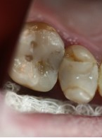 Pionowe złamanie korzenia drugiego zęba przedtrzonowego szczęki (...)