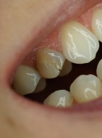 Veneerlay – estetyczna i funkcjonalna technika rekonstrukcji (...)