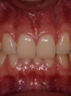 Fotografia stomatologiczna – wpływ lampy błyskowej na zdjęcia