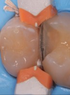 Różne metody leczenia ubytków próchnicowych na powierzchniach stycznych