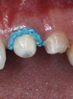 Wykonanie wycisku przedniego zęba szczęki z wykorzystaniem pasty retrakcyjnej