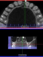 Endodoncja czy implantologia?