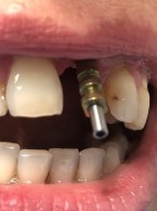 Utrata zęba siecznego przyśrodkowego w szczęce (...)