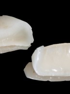 Odbudowa złamanych zębów siecznych przyśrodkowych szczęki (...)