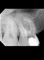 Postępowanie w przypadku złamania instrumentów. Opis przypadków